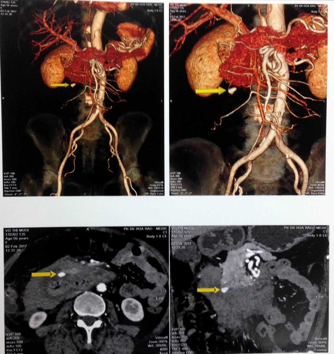 VIETNAMESE MEDIC ULTRASOUND CASE 416 RETROPERITONEUM HEMATOMA, Dr