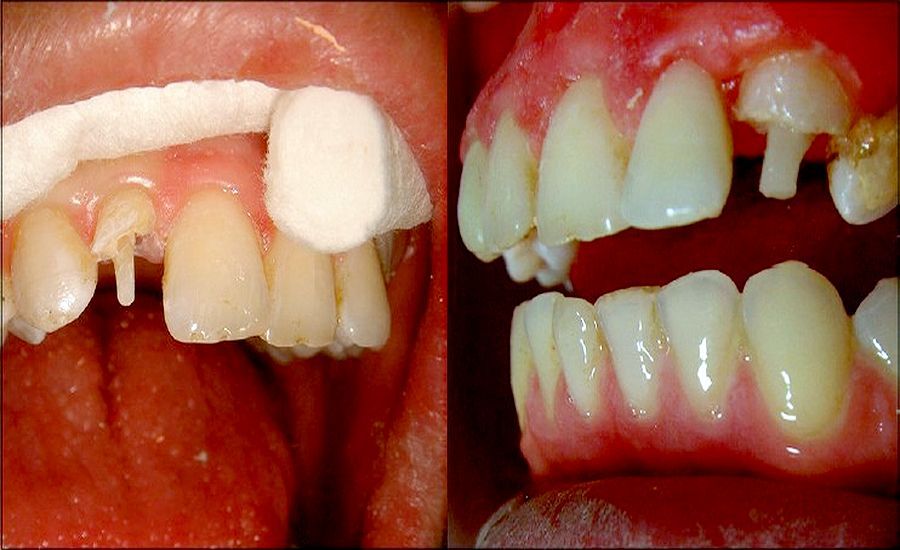 PDF Nonmetallic postendodontic restorations a systematic review