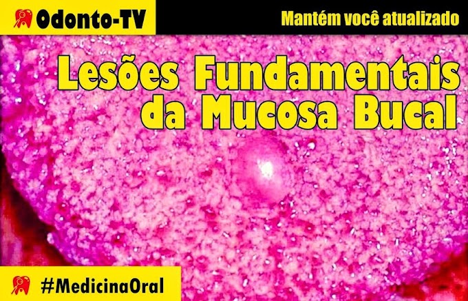 MEDICINA ORAL: Lesões Fundamentais da Mucosa Bucal