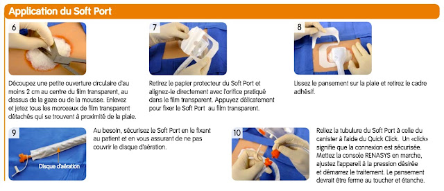 Traitement des plaies par Pression Négative (TPN) | Récap' IDE