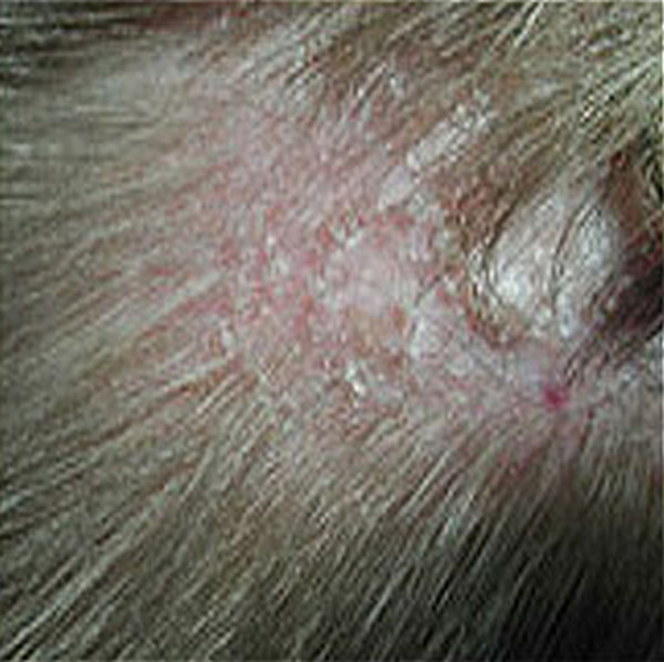 Itchy Scalp or Neck : Conditions, Treatments, and Pictures ...