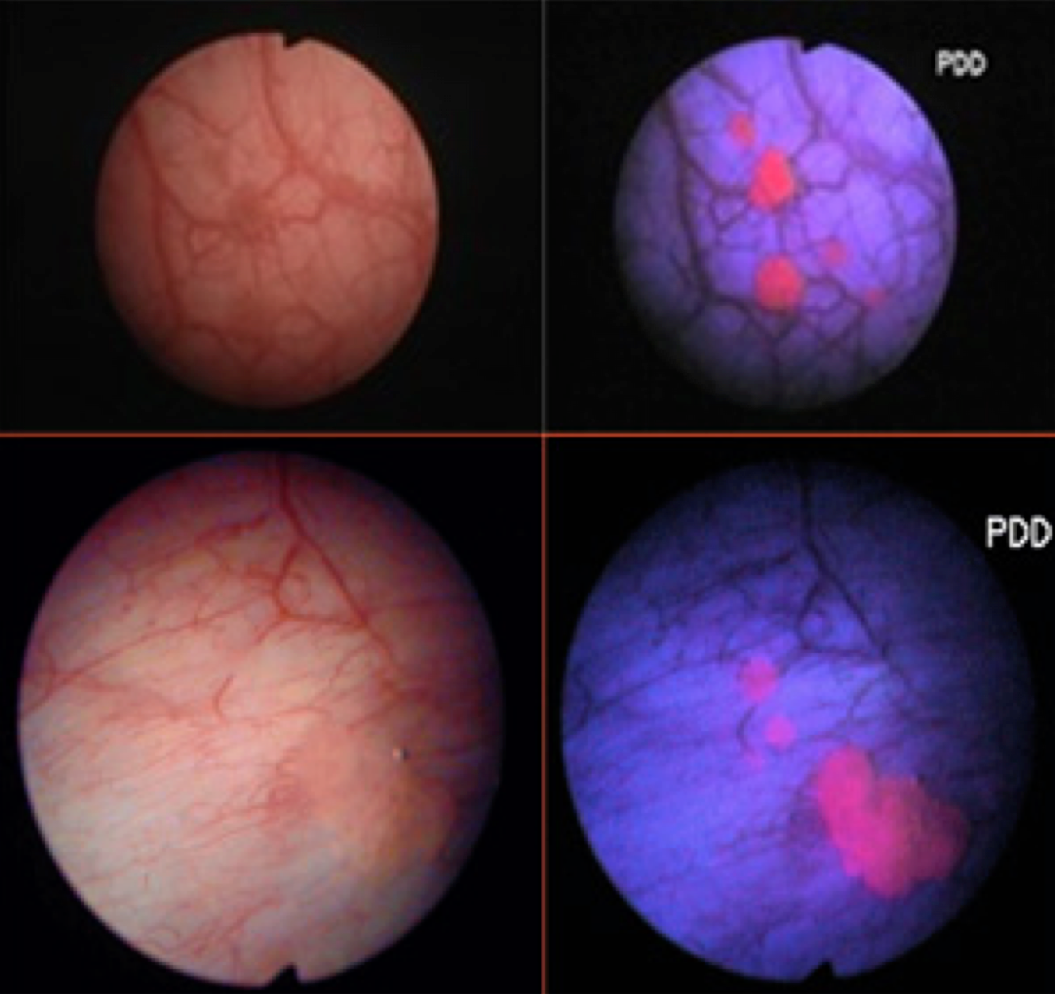 Madrid Urología Cáncer de Vejiga. Diagnóstico Estudio. MU. Capítulo 3. Sección 2. Madrid Urología Cáncer de Vejiga. Diagnóstico Estudio. MU. Capítulo 3. Sección 2.