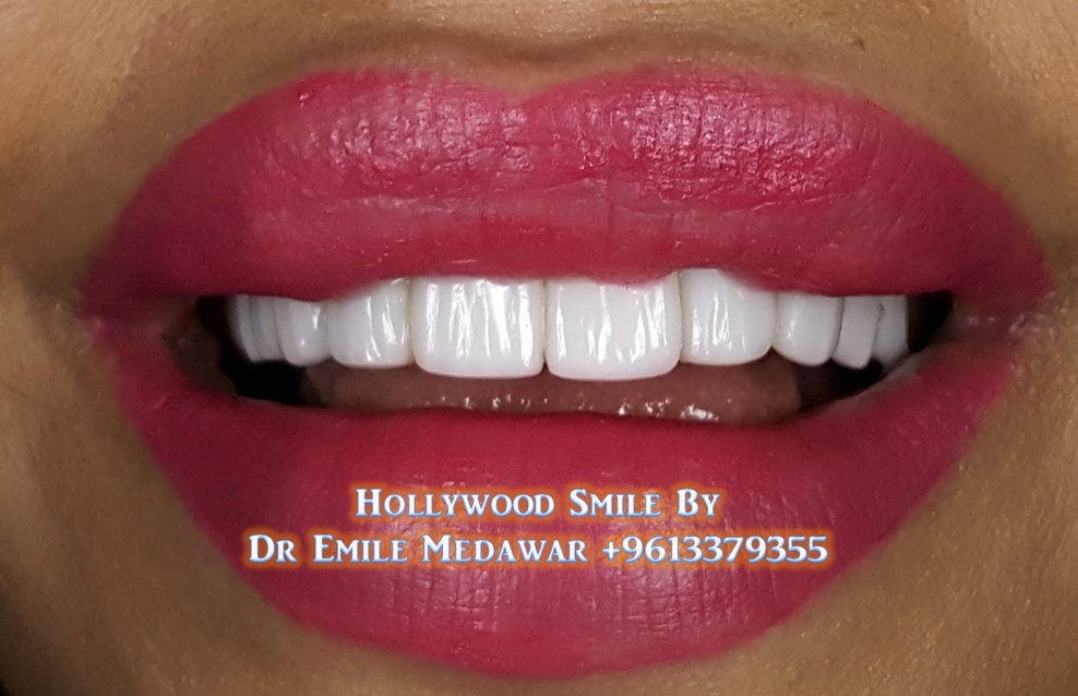 Dr Emile Medawar Veneers Smile, 00 961 3 379355 Smile Perfection by