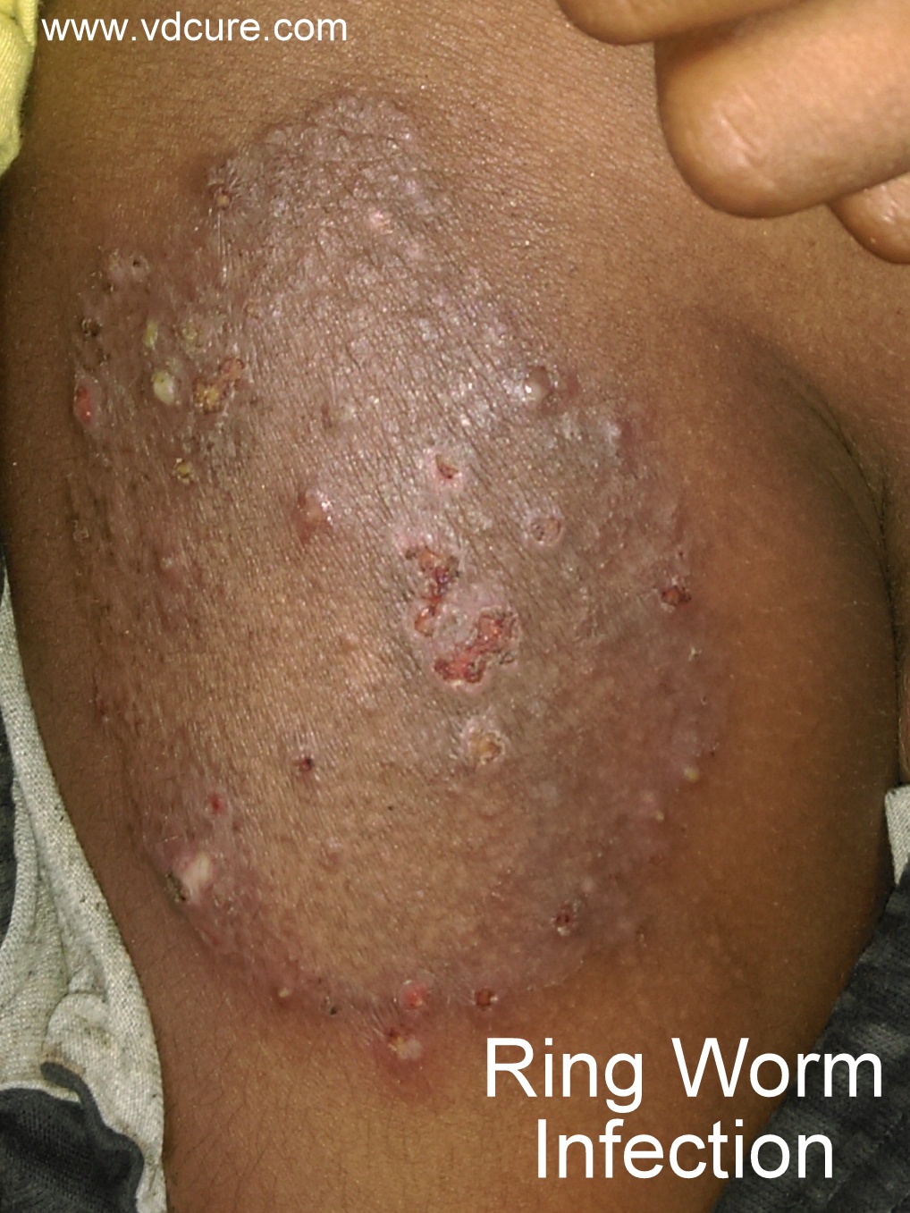 Treatment For Ring Worms Treatment For Ring Worms