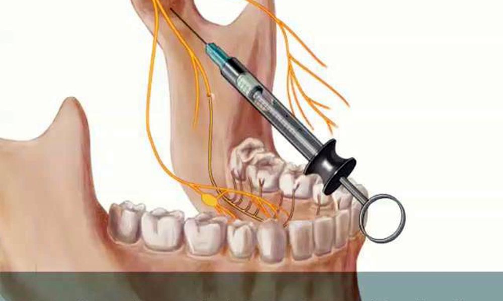 Dental anesthesia