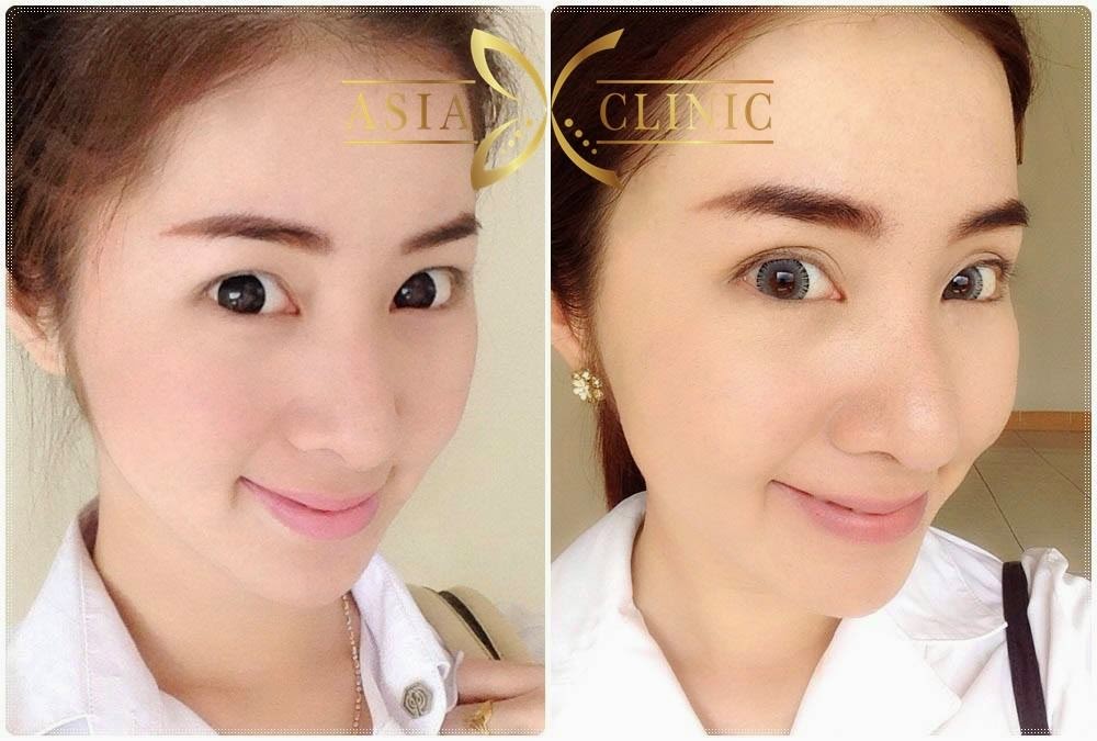 Cosmetics Surgery Thailand Eyelid Surgery