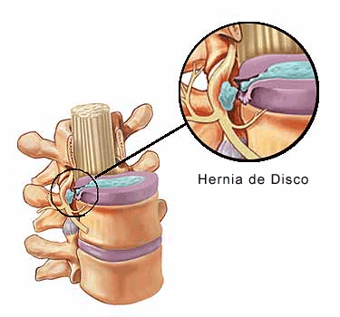 Hernia discal que es y como se produce YouTube - Imagenes De Hernia Discal Lumbar