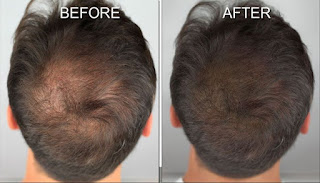hair transplant results at face value clinic