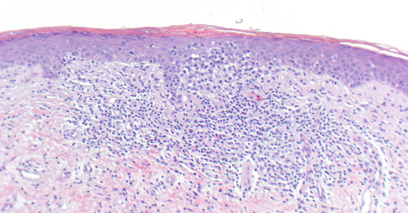 VIRTUAL GRAND ROUNDS IN DERMATOLOGY 2.0: Mycosis Fungoides