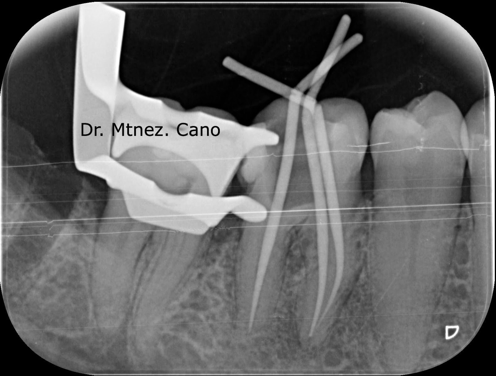 endodonciamississippi: Endodoncia molar #3.6 tratado por el Dr ...