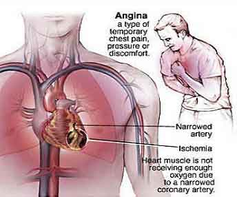 5 Nursing Diagnosis for Angina Pectoris