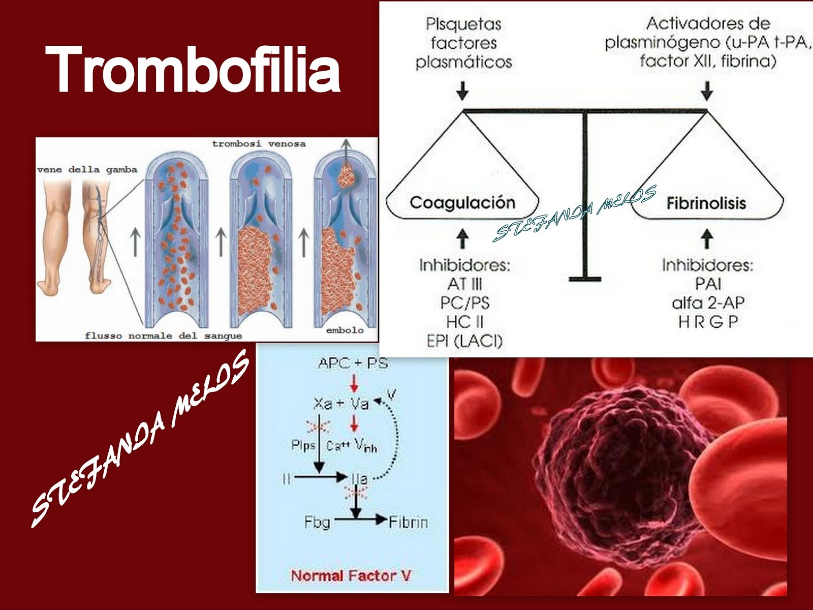 la Sclerosi multipla .. Ccsvi vista