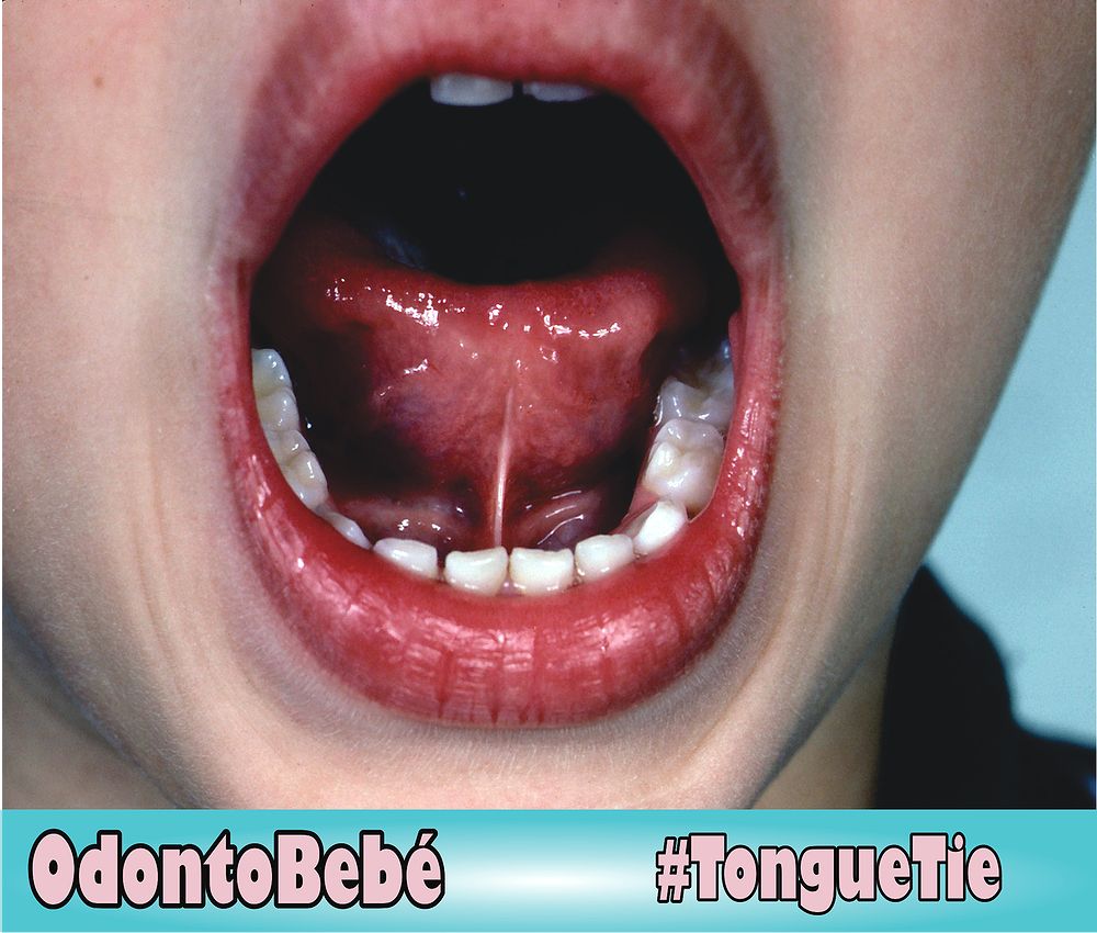 TONGUE TIE What are the symptoms of Tongue Tie? odontobebe