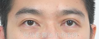 眼瞼下垂|提眼肌手術|兩眼無神|眼瞼下垂(提眼肌)手術案例分享 眼瞼下垂|提眼肌手術|兩眼無神|眼瞼下垂(提眼肌)手術案例分享