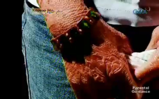 Fishy Skin Living With Ichthyosis Vulgaris Lamellar Ichthyosis In