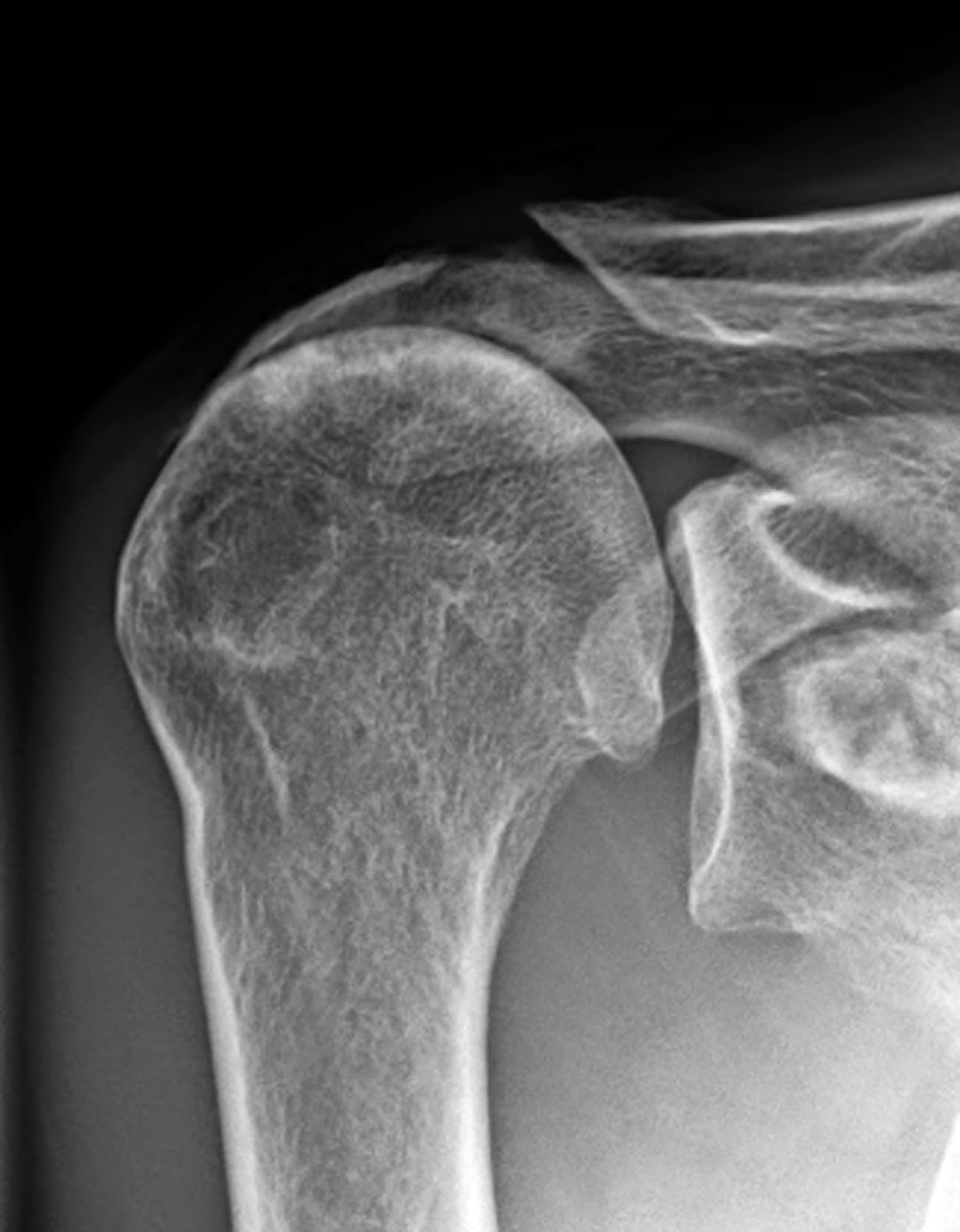Degenerative Rotator Cuff Tear