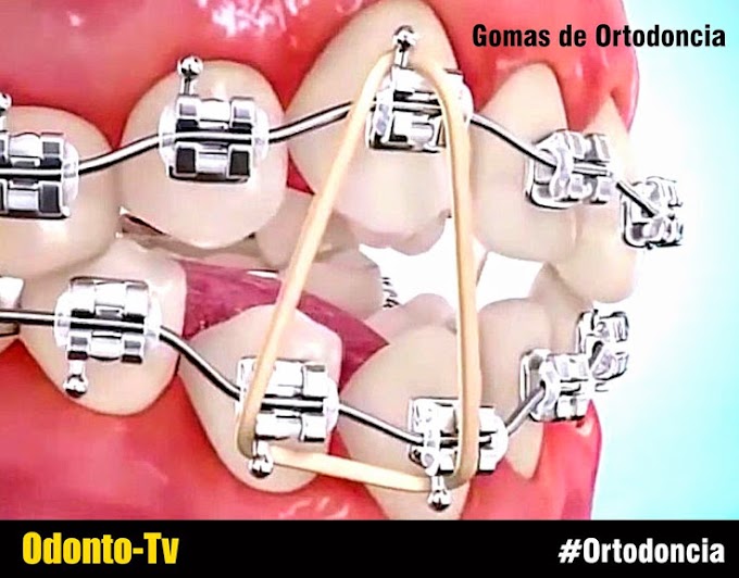 ORTODONCIA: Gomas ¿Cómo y cuándo se colocan?