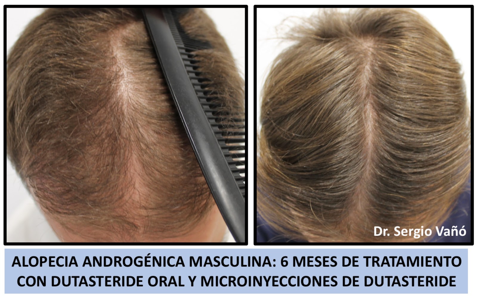 Como cuidar do seu cabelo para evitar a queda