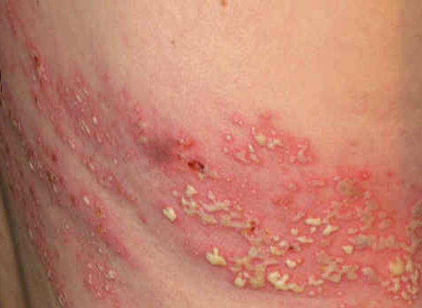 herpes rashes pictures #10