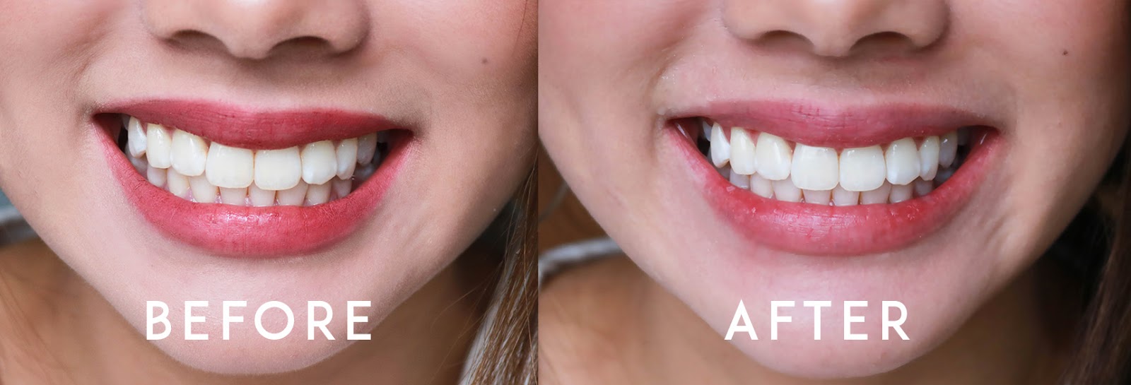 pop smile results, honest , before and after