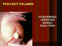 Artikel Obat Tradisional Gonore