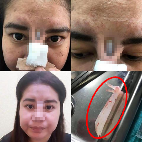 Hidung Wanita ini Berubah Menjadi Mengerikan Setelah Operasi Plastik yang Gagal