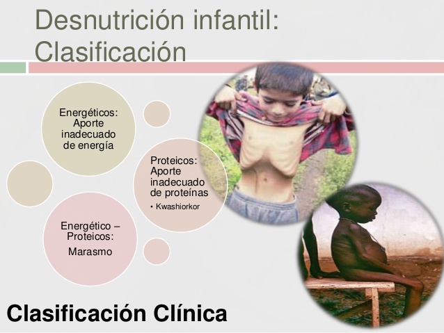DESNUTRICIÓN INFANTIL