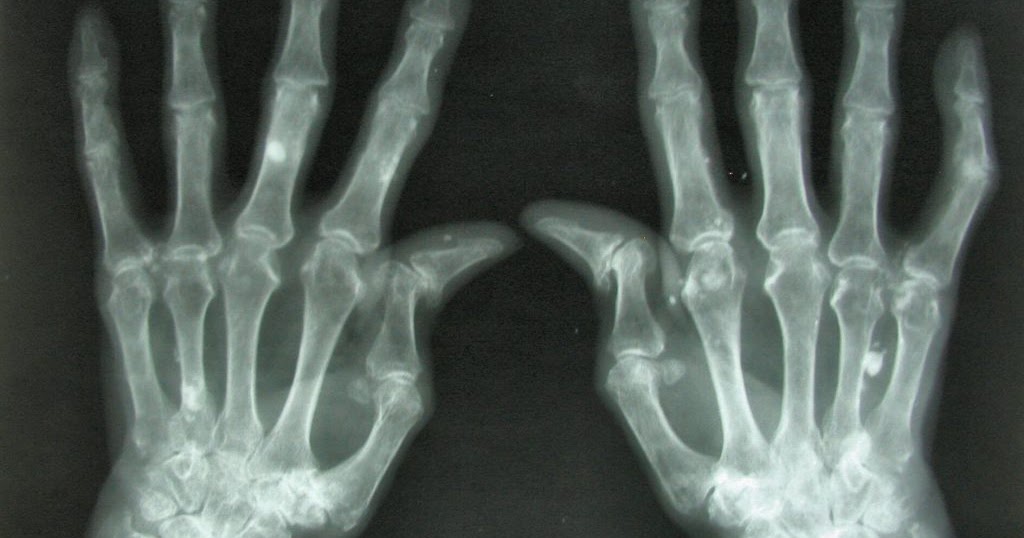 Agent Orange Zone Pollution Promotes Rheumatoid Arthritis