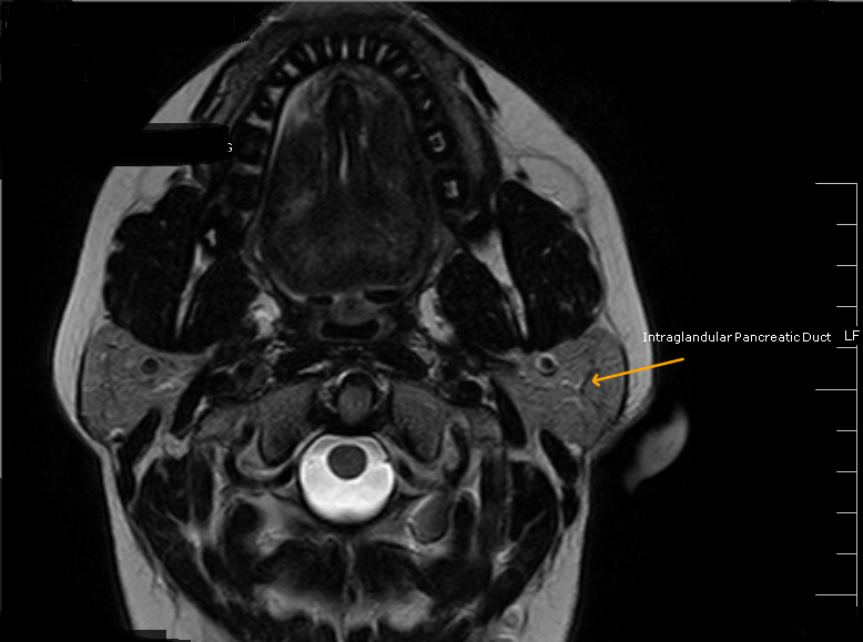 Stensen's DuctMRI Sumer's Radiology Blog