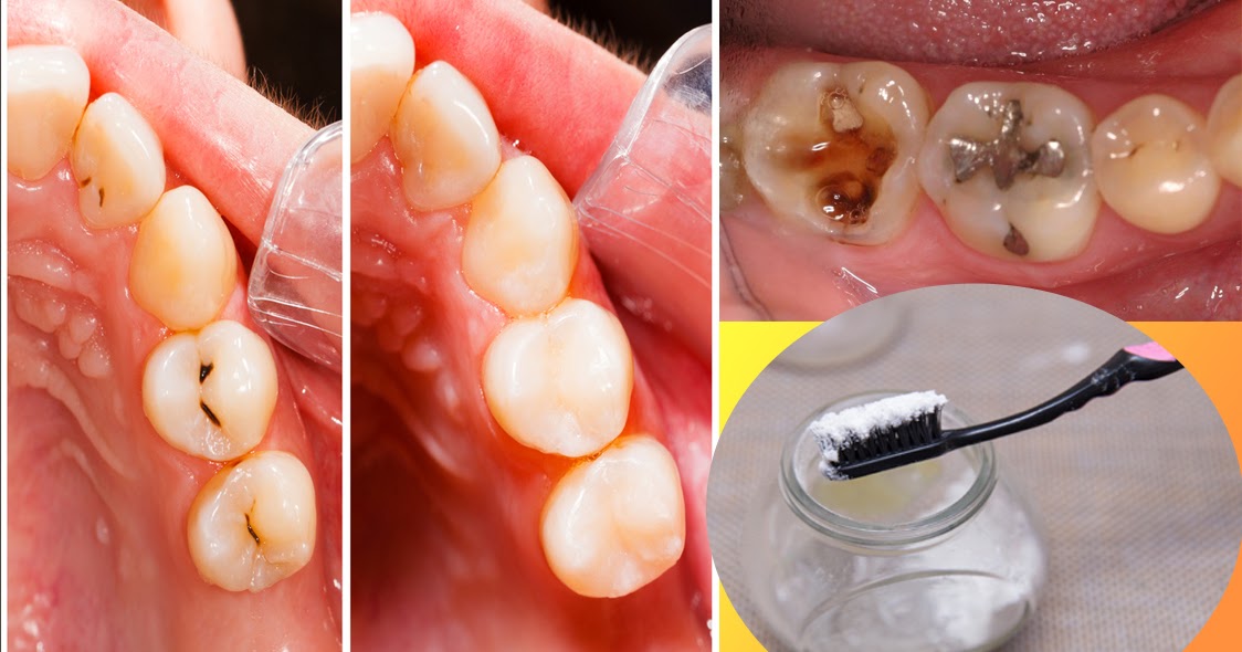 Easily REMOVE Cavities With This 4 Simple Steps!