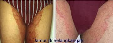 Foto Obat salep gatel gatel pada kemaluan pria,berbahan alami cepat sembuh