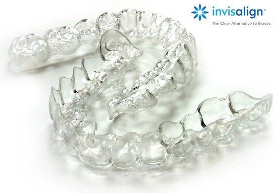 Khay niềng răng Invisalign