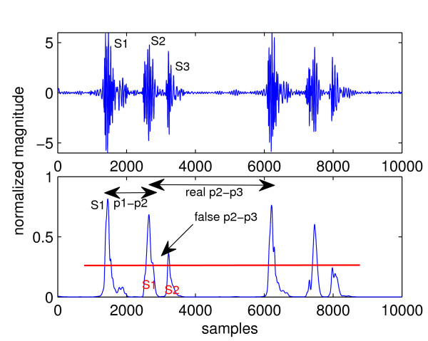 Absorb Medicine Third Heart Sound S3 