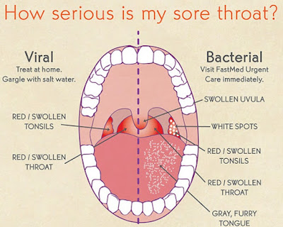 Natural Antibiotics To Cure Strep Throat Natural Antibiotics To Cure Strep Throat