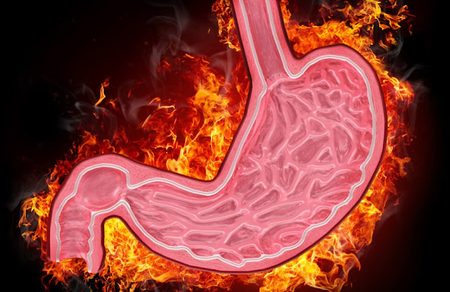 Waspada, Inilah Penyebab Asam Lambung Naik yang Banyak Dilanggar Orang Waspada, Inilah Penyebab Asam Lambung Naik yang Banyak Dilanggar Orang