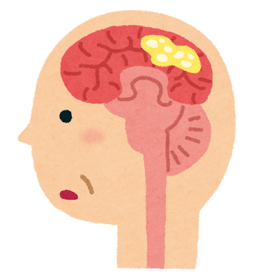 認知症の脳のイラスト（レビー小体型）