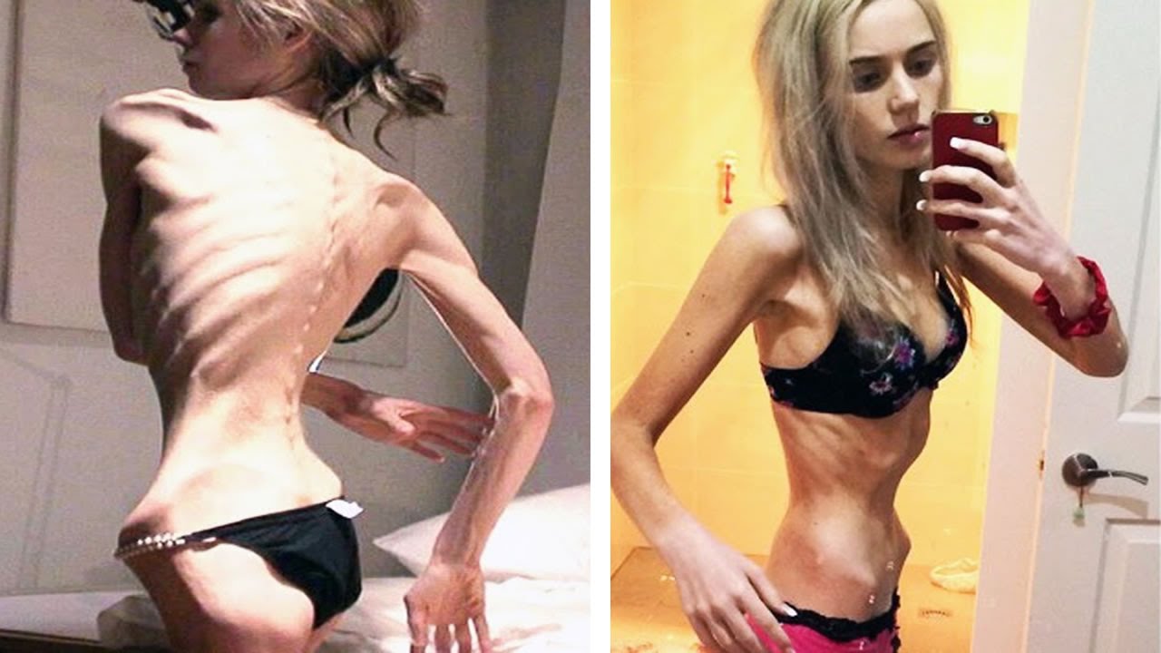 Cetosis anorexia