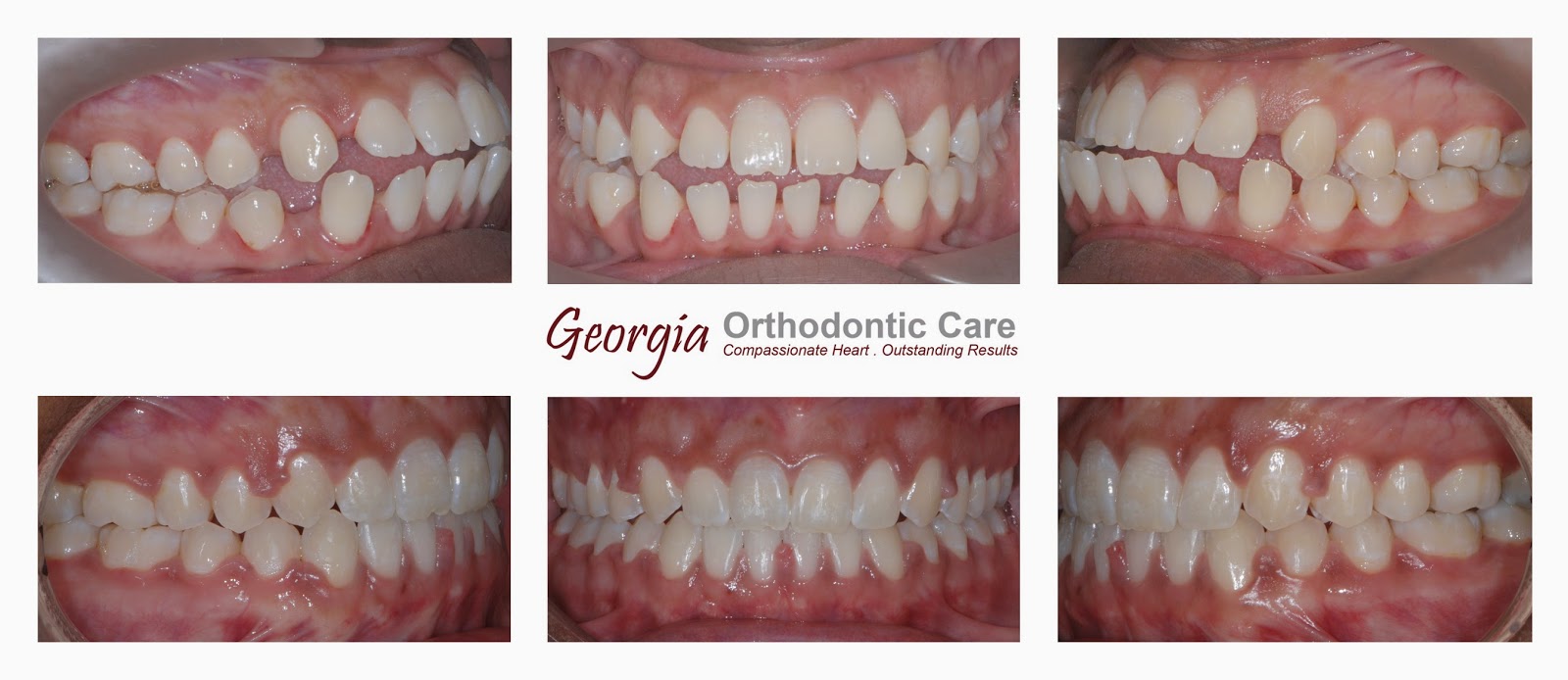 ORTHODONTIC CARE LAWRENCEVILLE & NORCROSS GA Patient with
