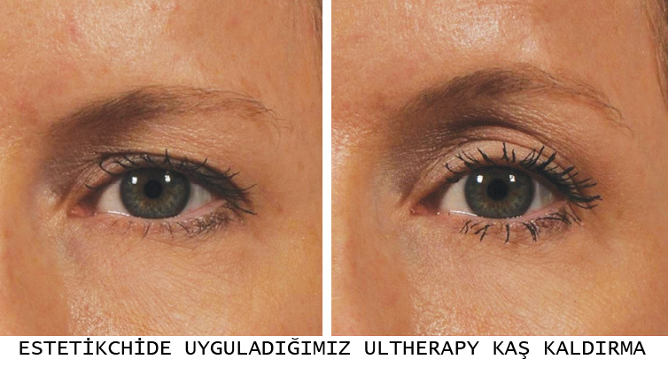 Ulthera Ultherapy Maltepe