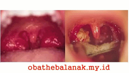 Cara Mengobati Difteri Pada Anak Secara Ampuh Cara Mengobati Difteri Pada Anak Secara Ampuh