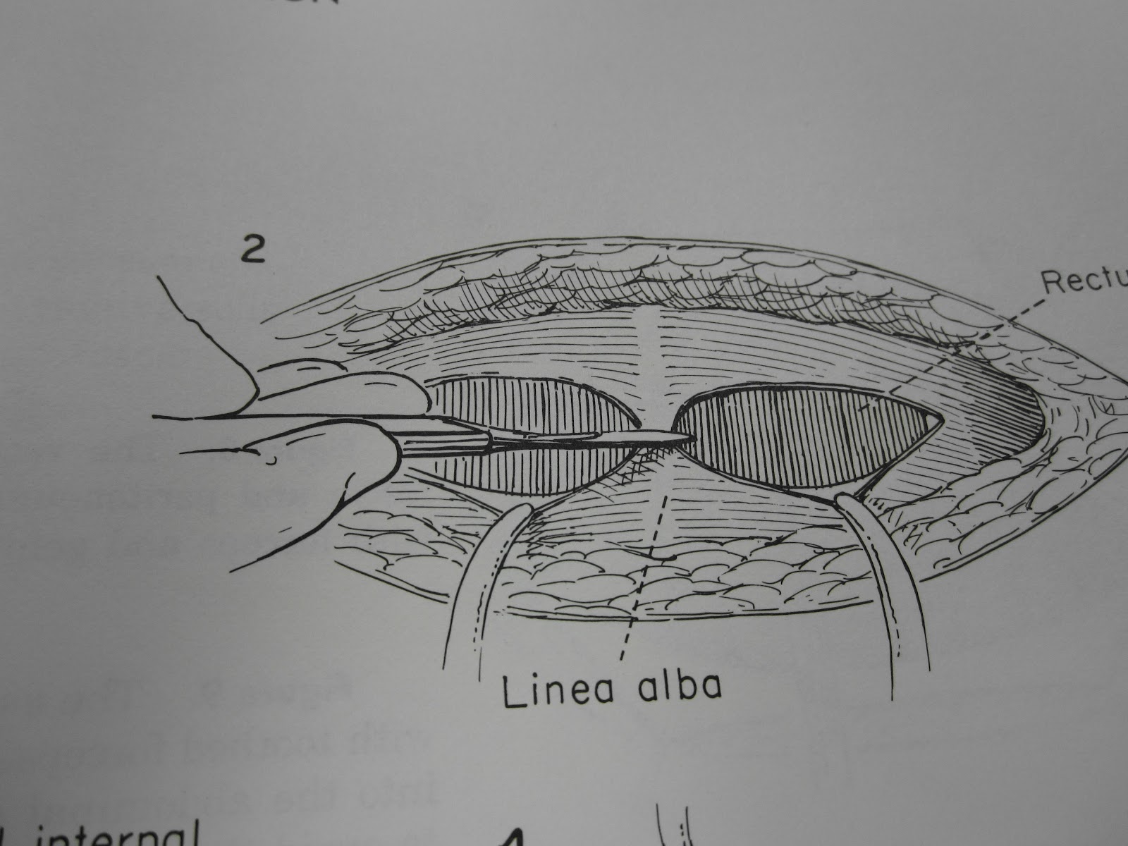 The Pfannenstiel Incision: Opening and Closing the Tummy