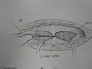 The Pfannenstiel Incision: Opening and Closing the Tummy