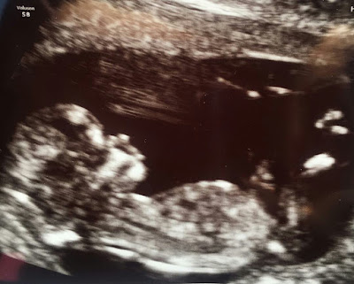 11 haftalık gebelik görüntüsü