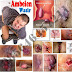 Anda Terkena Wasir (Hemoroid)?? Ini Cara Mengobatinya thumbnail