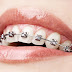 Quy trình niềng răng khểnh tại nha khoa