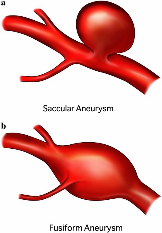 aneurysm aphorisms: Anatomy is destiny. ~ Sigmund Freud