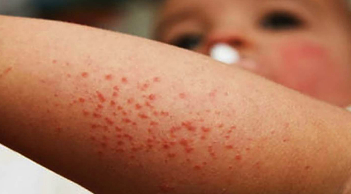 Grave Epidemia di Morbillo nelle Filippine.