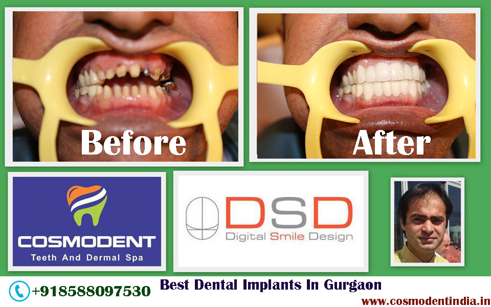 Cosmodent Dental Clinic Best Dental Implantologist in India Dental