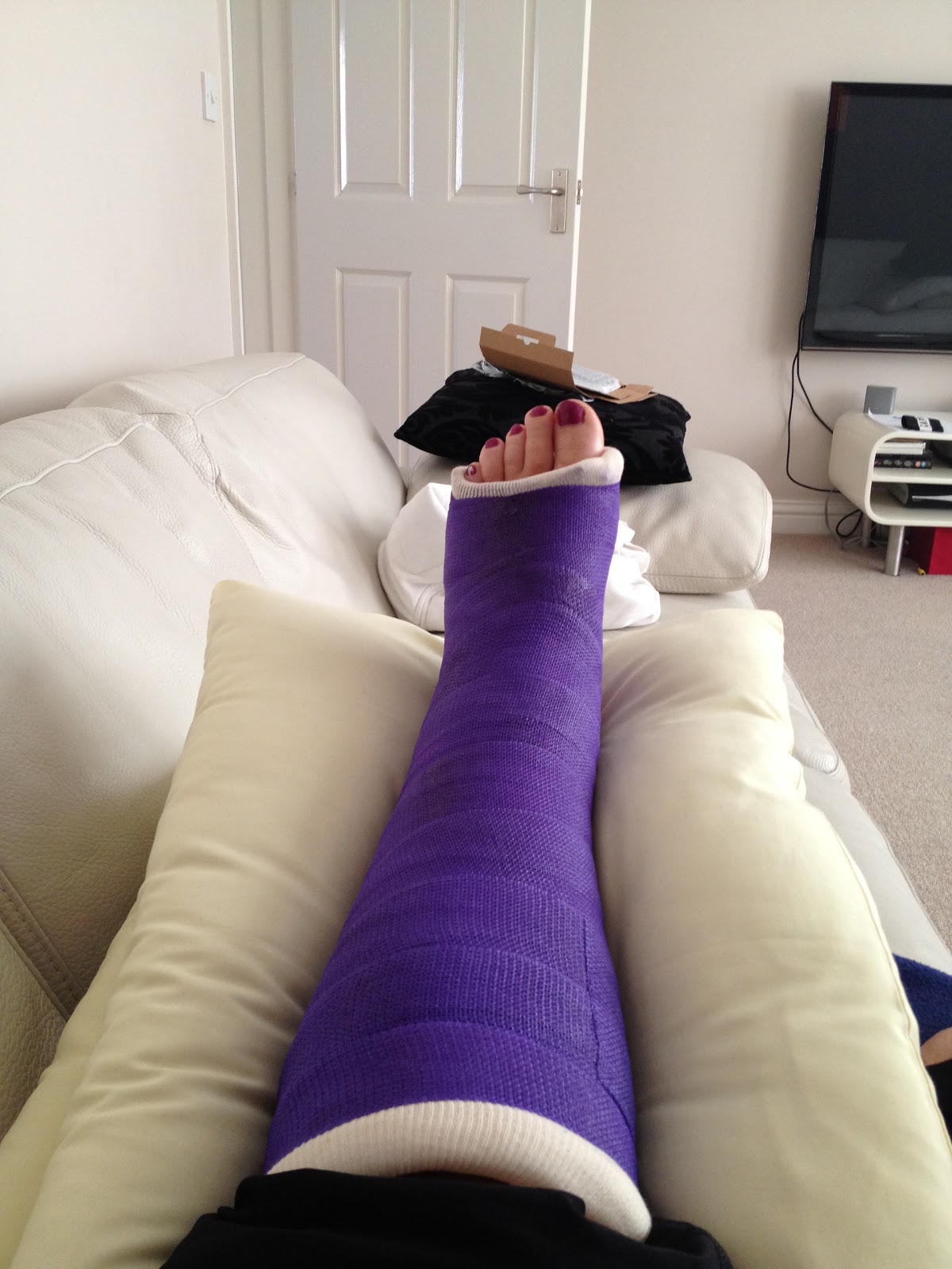 From Cornwall to Crutches - Trimalleolar Fracture: Purple casts are the What Has Long Hair And Purple Feet