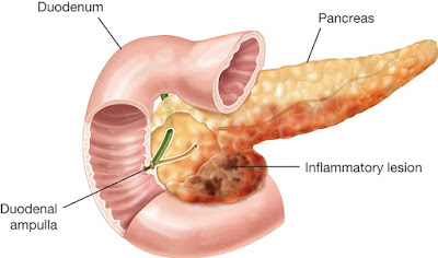 Acute Pancreatitis Treatment in Chennai Acute Pancreatitis Treatment in Chennai